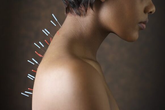 akupunktura na bolest zad