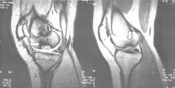 rentgen osteochondrosis dissecans v kolenním kloubu
