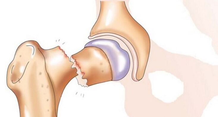 Zlomenina krčku stehenní kosti je doprovázena silnou bolestí v kyčelním kloubu