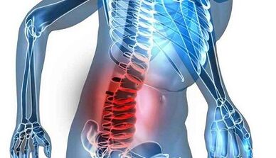 Příznaky a příznaky bederní osteochondózy